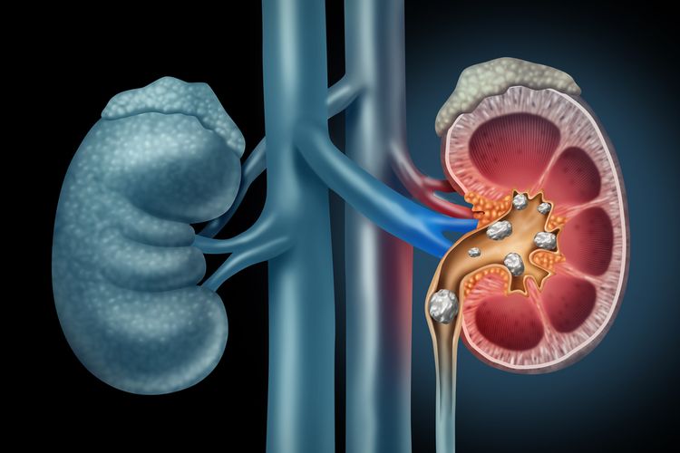 Presentase Pasien Melanoma Ginjal Di Usia Muda Semakin Meningkat